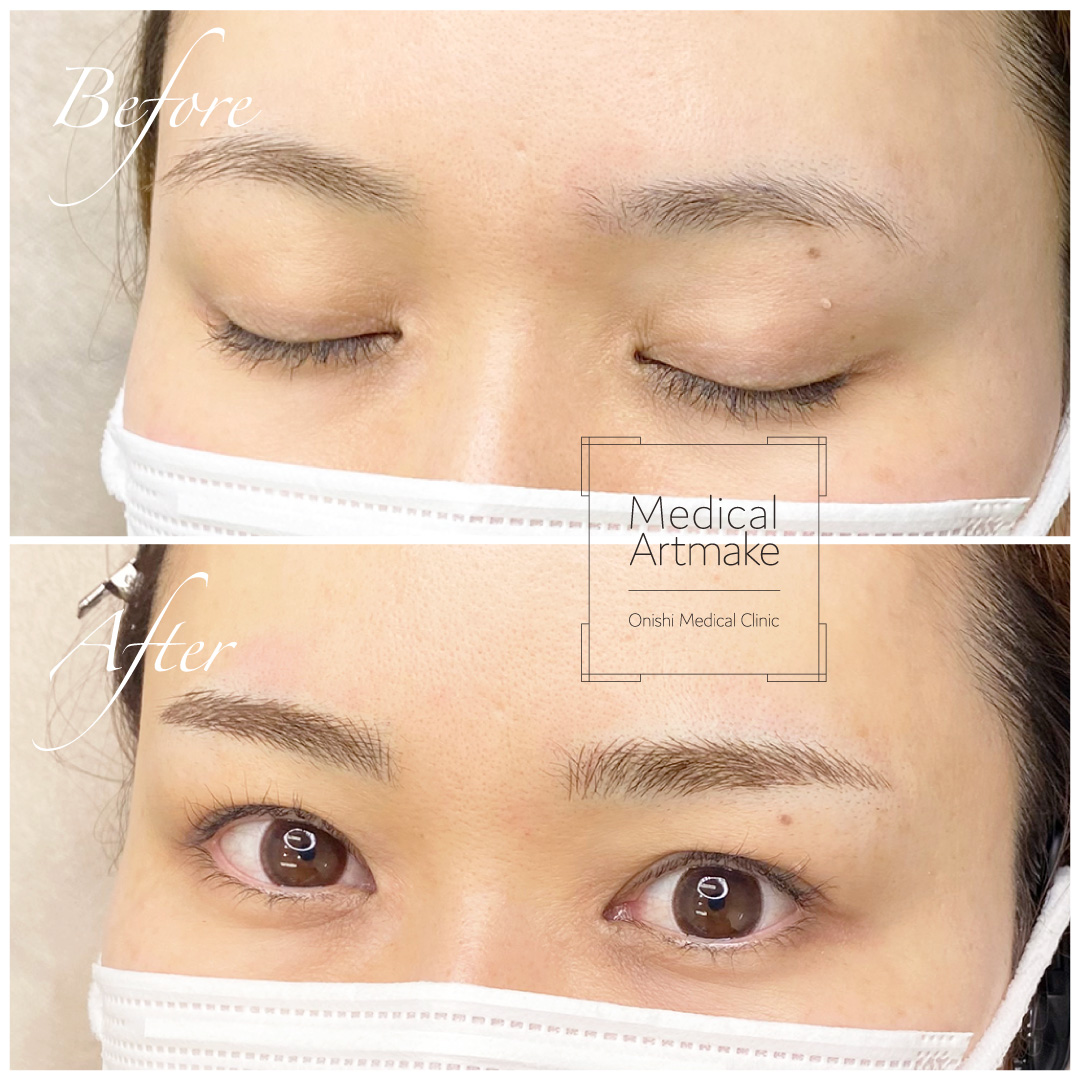 加古川で眉毛の医療アートメイクなら 大西メディカルクリニック 美容