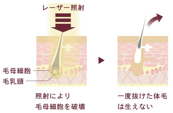 大西メディカルで使用する医療レーザーの仕組み断面図。照射により毛母細胞を破壊。一度抜けた体毛は生えない。